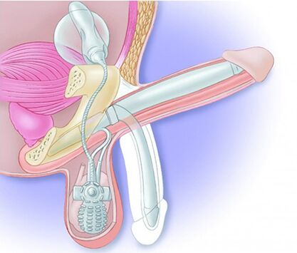 Peeniseproteesid taastavad erektsiooni ja muudavad peenise suuremaks